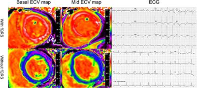 Electrocardiogram Characteristics and Prognostic Value in Light-Chain Amyloidosis: A Comparison With Cardiac Magnetic Resonance Imaging